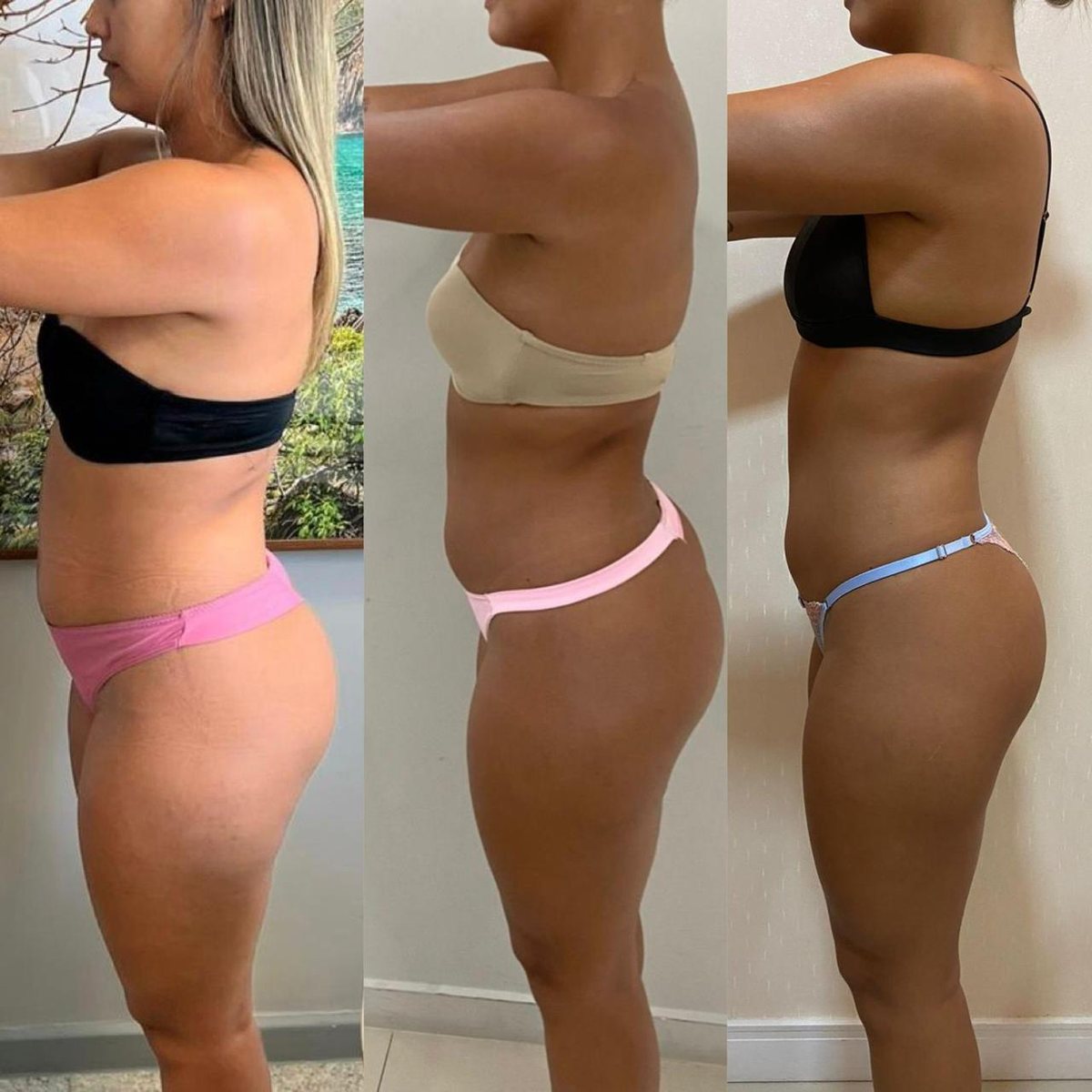 Paciente de perfil em três momentos do tratamento com lipoenzimas, com o contorno do abdômen diminuindo